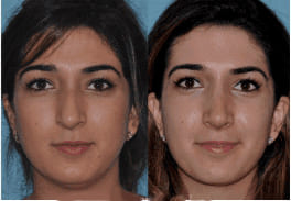 Crooked Nose Treatment in India