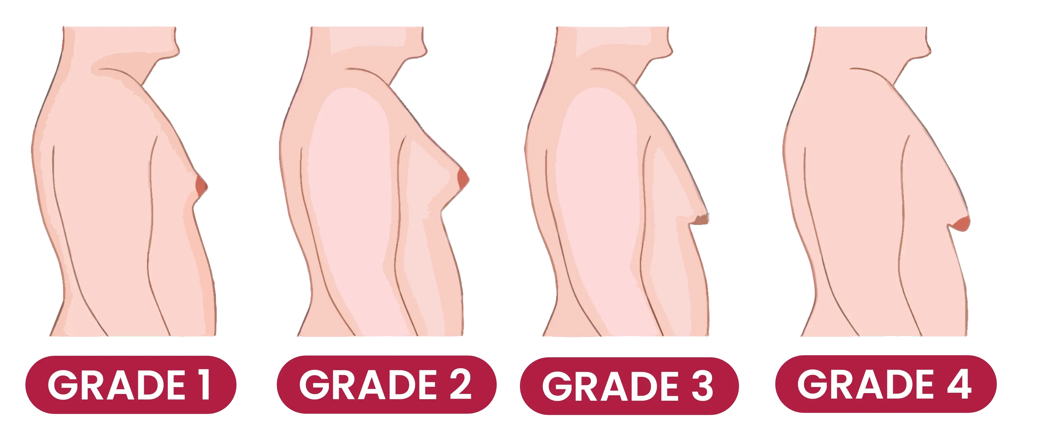 Gynecomastia Surgery in India | Male Breast Reduction in India