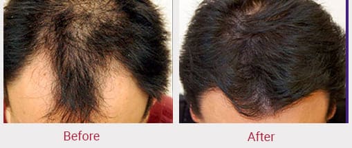 Hair Transplant in Indore – Hair Transplant Cost & price in Indore at  Zenith Hair Transplant Clinic