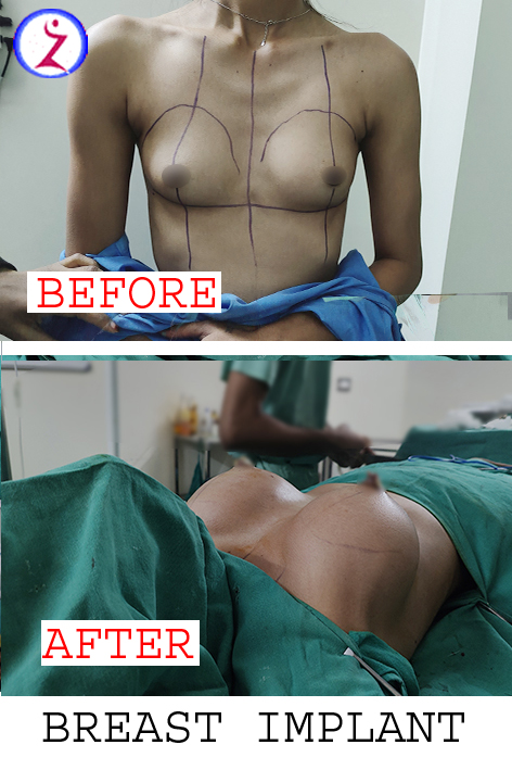 Enlarged correct breast surgery silicone implantation small size droop pain  women shape fat transfer lift asymmetrical nipple sag rejuvenate skin scar  Stock Vector