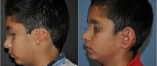 ear-reconstruction-indore-india