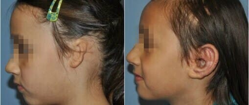 ear-reconstruction-surgery-indore-india