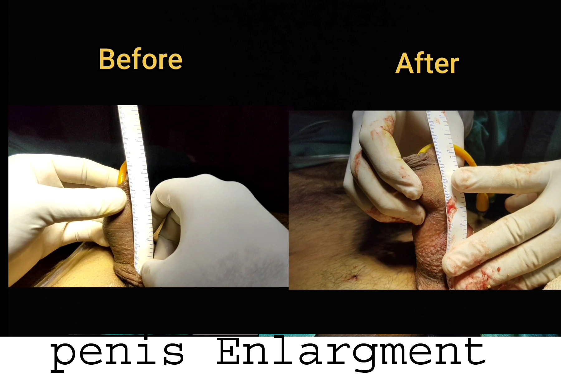 Penis Enlargement Surgery in Indore - increase penis thickness and length  in Indore, Cost Price in Indore, Bhopal, Before After Photos, Results